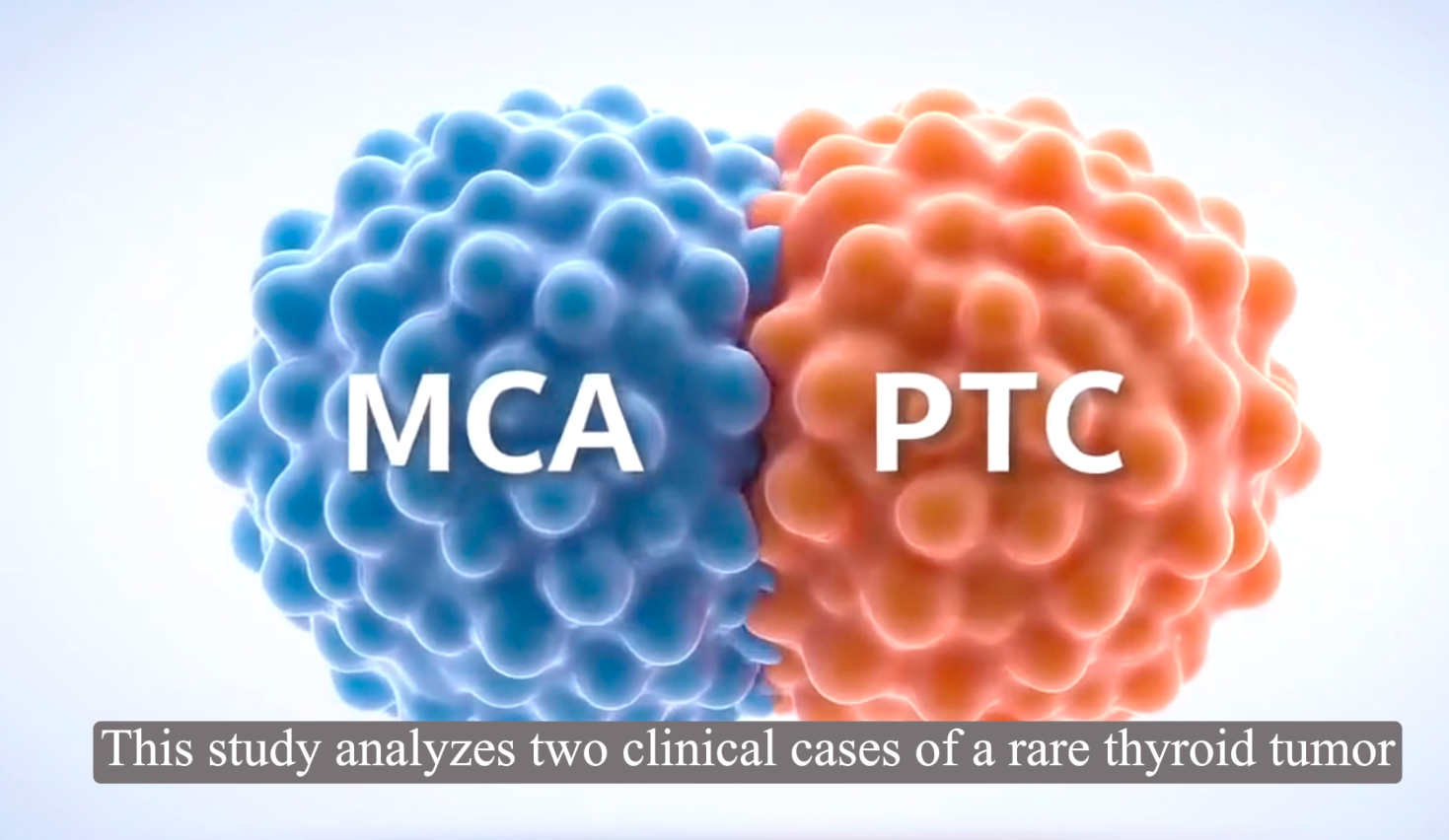 Two Cases of Mixed Medullary and Follicular Cell Carcinoma with
Literature Review